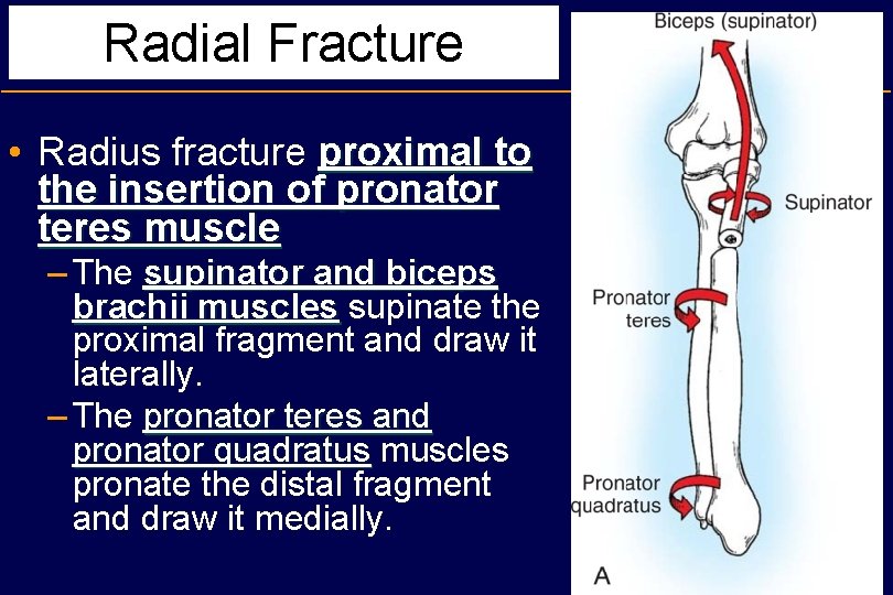 Radial Fracture • Radius fracture proximal to the insertion of pronator teres muscle –
