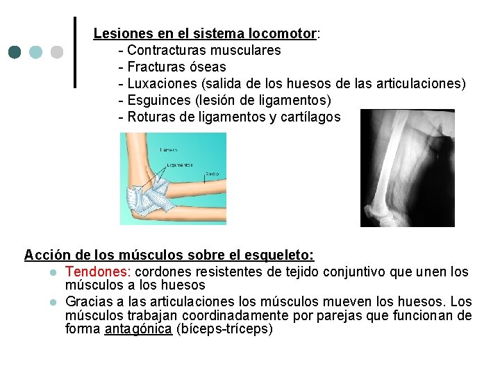 Lesiones en el sistema locomotor: - Contracturas musculares - Fracturas óseas - Luxaciones (salida Lesiones en el sistema locomotor: - Contracturas musculares - Fracturas óseas - Luxaciones (salida