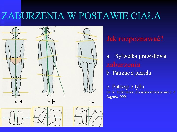 ZABURZENIA W POSTAWIE CIAŁA Jak rozpoznawać? a. Sylwetka prawidłowa zaburzenia b. Patrząc z przodu