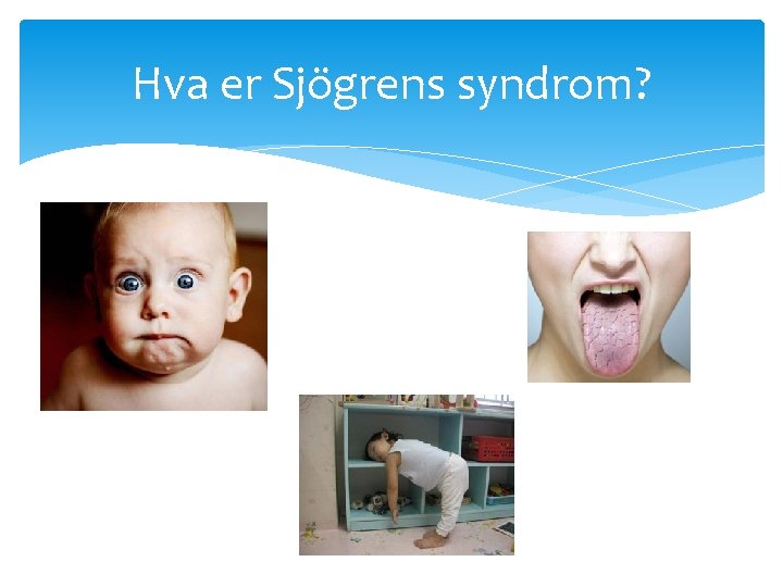 Hva er Sjögrens syndrom? 