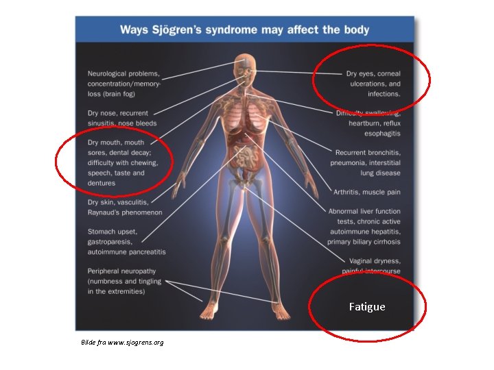 Fatigue Bilde fra www. sjogrens. org 