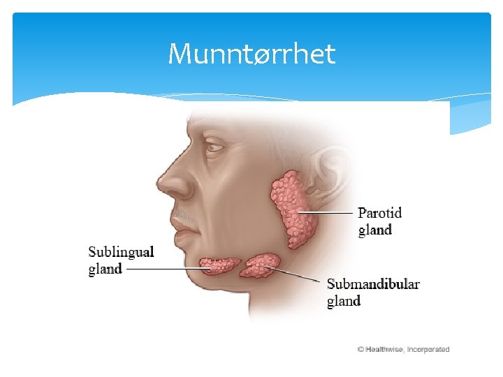 Munntørrhet 