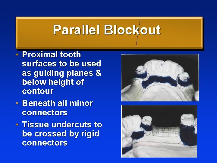 Parallel Blockout • Proximal tooth surfaces to be used as guiding planes & below