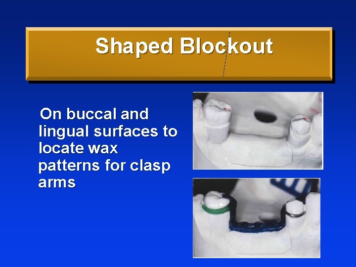 Shaped Blockout On buccal and lingual surfaces to locate wax patterns for clasp arms