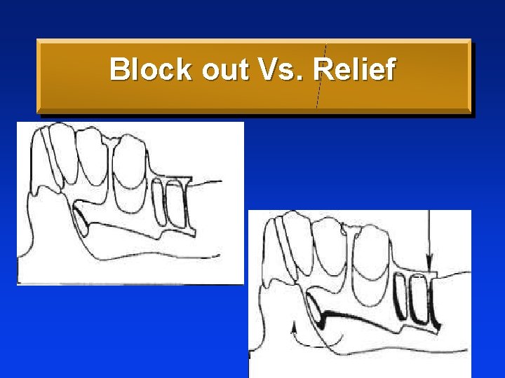 Block out Vs. Relief 