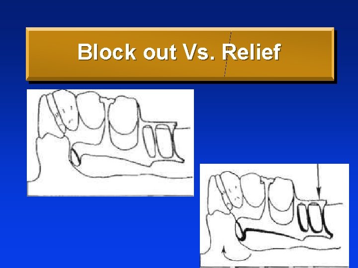 Block out Vs. Relief 