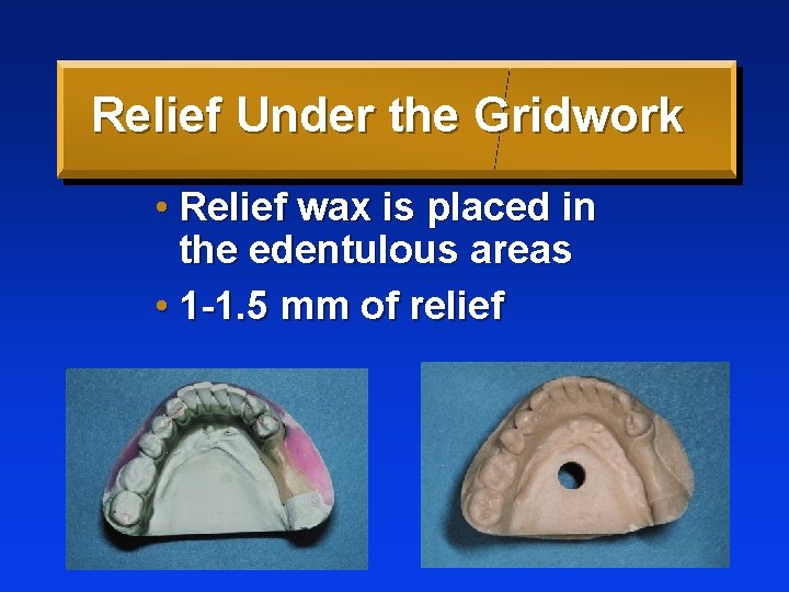 Relief Under the Gridwork • Relief wax is placed in the edentulous areas •