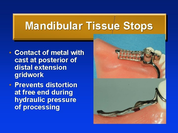 Mandibular Tissue Stops • Contact of metal with cast at posterior of distal extension