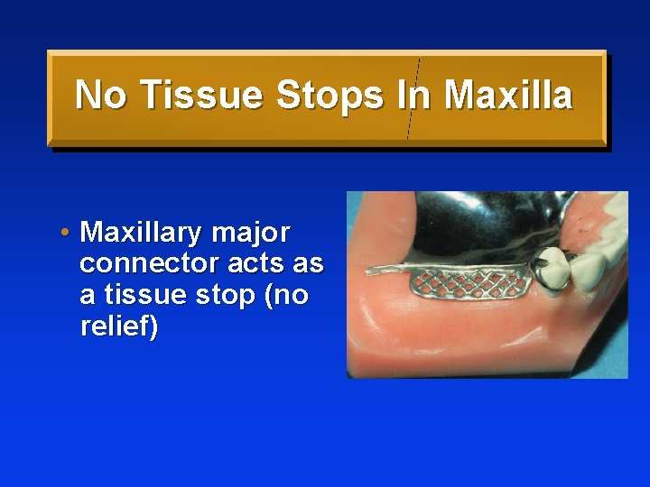 No Tissue Stops In Maxilla • Maxillary major connector acts as a tissue stop