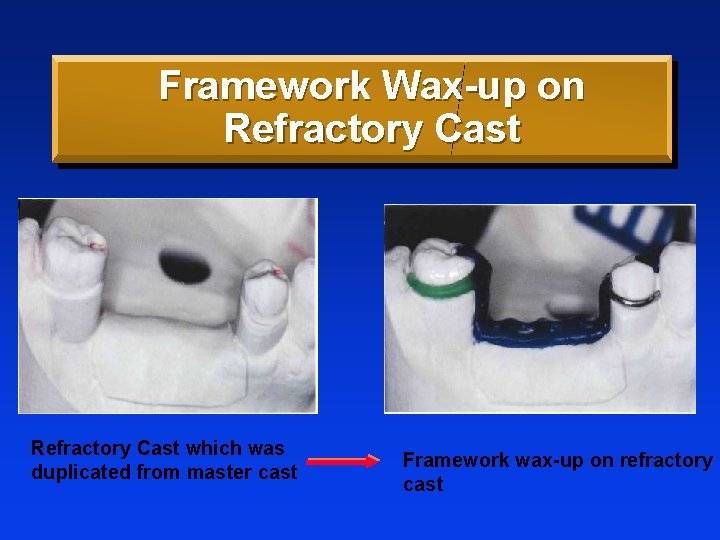 Framework Wax-up on Refractory Cast secondary cast Refractory Cast which was duplicated from master