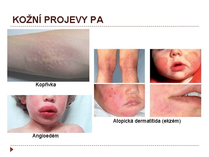 KOŽNÍ PROJEVY PA Kopřivka Atopická dermatitida (ekzém) Angioedém 