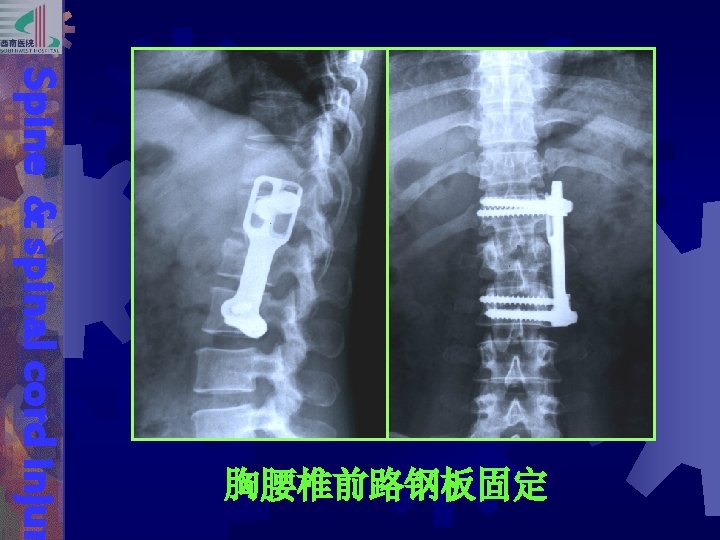 Spine & spinal cord injur 胸腰椎前路钢板固定 