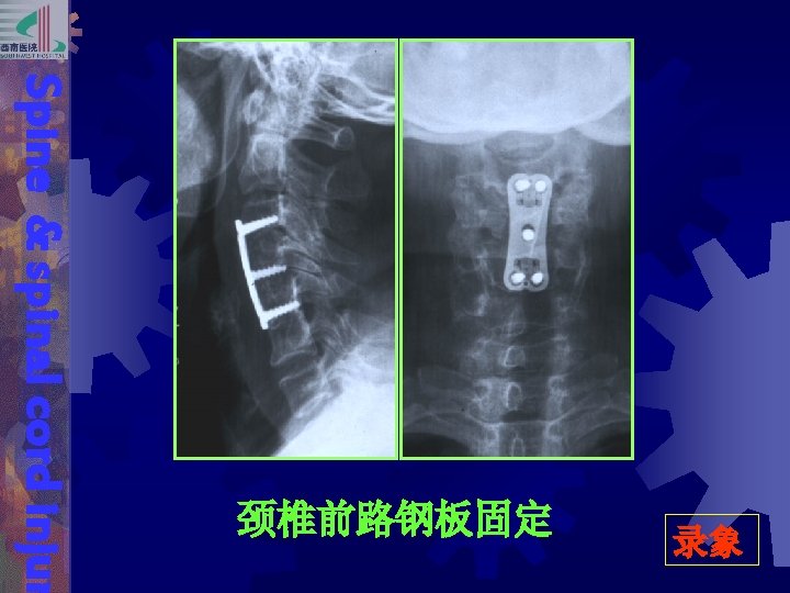 录象 Spine & spinal cord injur 颈椎前路钢板固定 