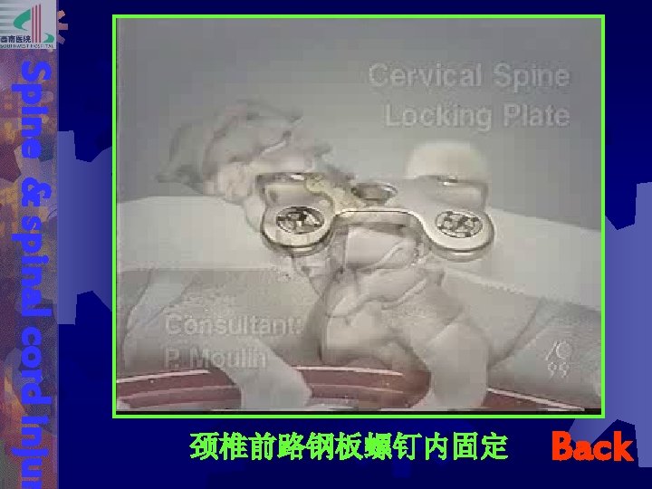 Back Spine & spinal cord injur 颈椎前路钢板螺钉内固定 