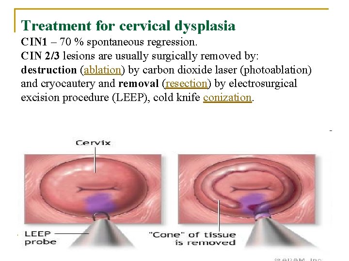 Treatment for cervical dysplasia CIN 1 – 70 % spontaneous regression. CIN 2/3 lesions