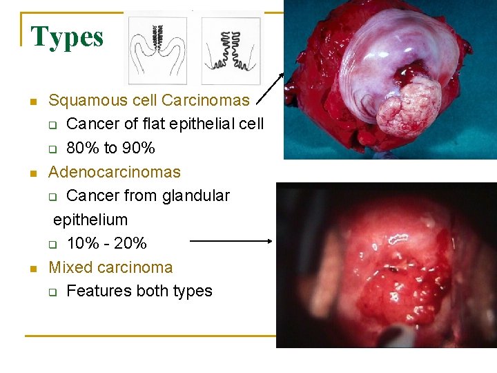 Types n n n Squamous cell Carcinomas q Cancer of flat epithelial cell q