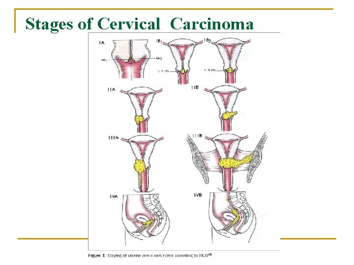 Stages of Cervical Carcinoma 