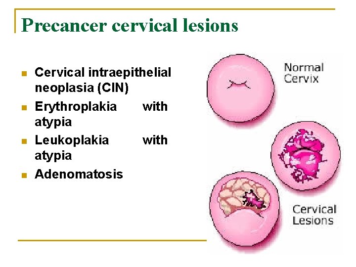 Precancer cervical lesions n n Cervical intraepithelial neoplasia (CIN) Erythroplakia with atypia Leukoplakia with