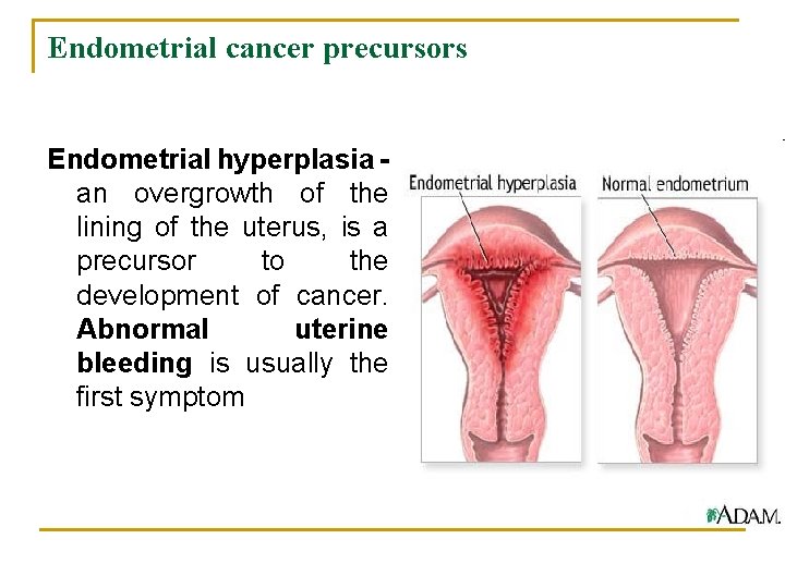 Endometrial cancer precursors Endometrial hyperplasia an overgrowth of the lining of the uterus, is