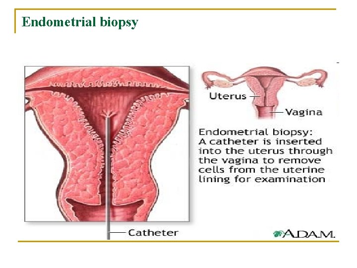 Endometrial biopsy 