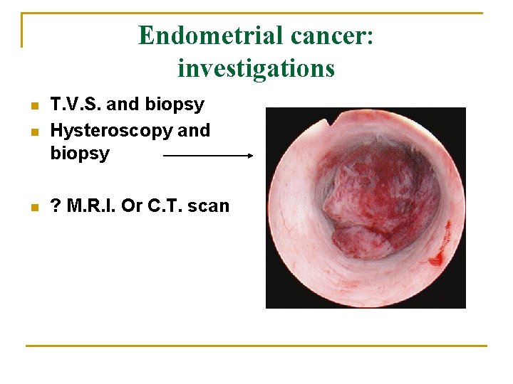 Endometrial cancer: investigations n T. V. S. and biopsy Hysteroscopy and biopsy n ?