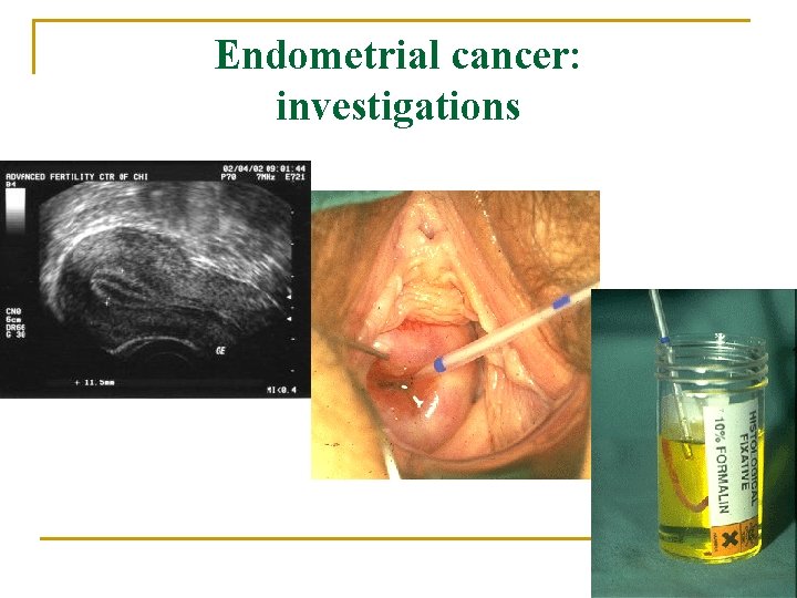 Endometrial cancer: investigations 