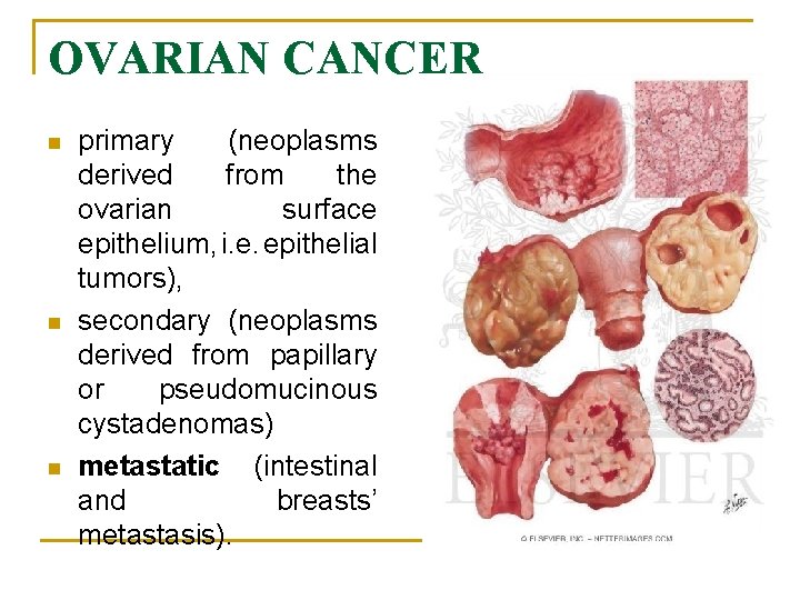 OVARIAN CANCER n n n primary (neoplasms derived from the ovarian surface epithelium, i.