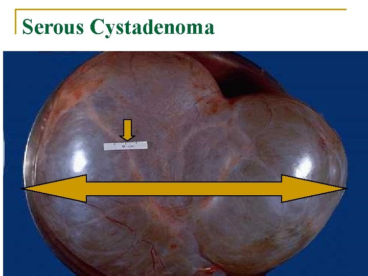 Serous Cystadenoma 