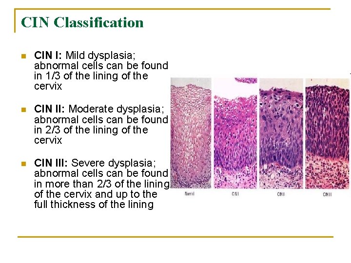 CIN Classification n CIN I: Mild dysplasia; abnormal cells can be found in 1/3