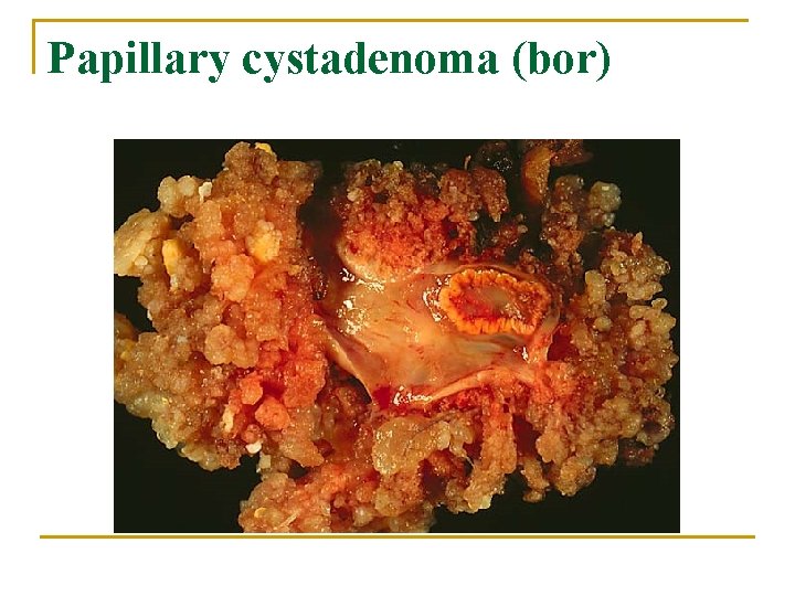 Papillary cystadenoma (bor) 