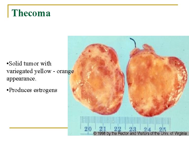 Thecoma • Solid tumor with variegated yellow - orange appearance. • Produces estrogens 