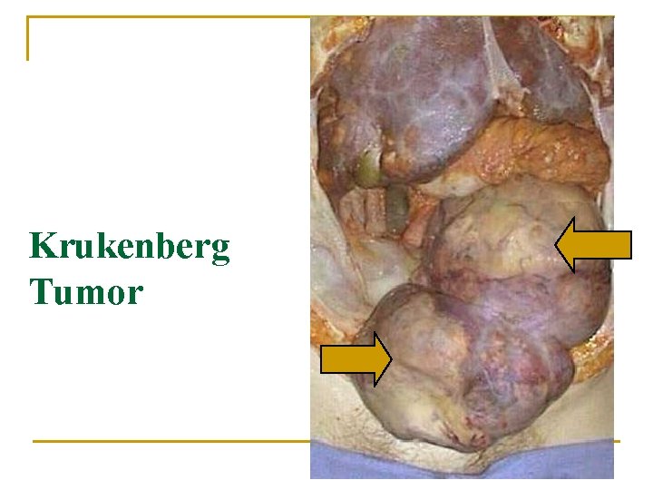 Krukenberg Tumor 