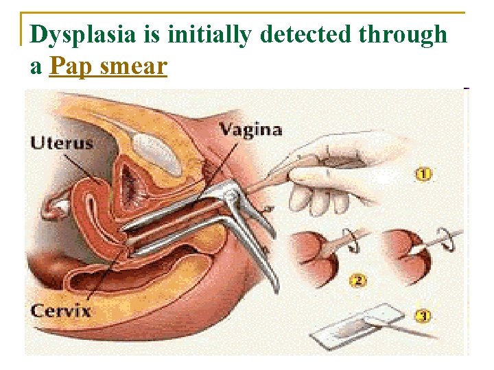 Dysplasia is initially detected through a Pap smear 