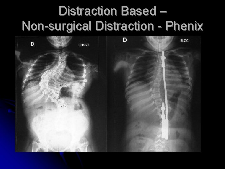 Distraction Based – Non-surgical Distraction - Phenix Distraction Based – Non-surgical Distraction - Phenix