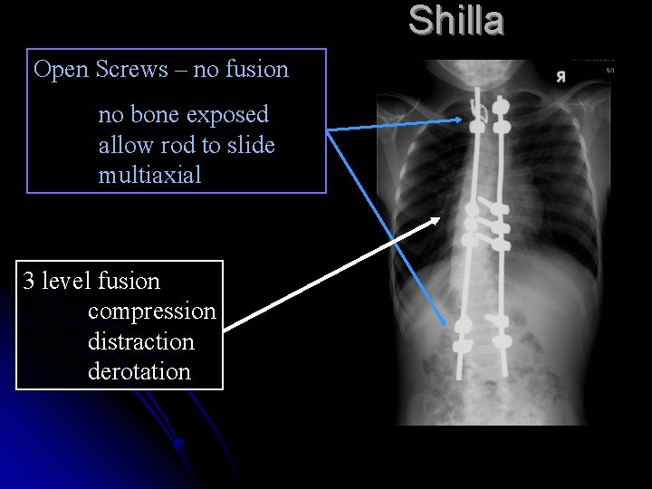 Shilla Open Screws – no fusion no bone exposed allow rod to slide multiaxial Shilla Open Screws – no fusion no bone exposed allow rod to slide multiaxial