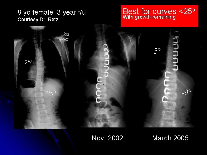 8 yo female 3 year f/u Courtesy Dr. Betz Best for curves <25 o 8 yo female 3 year f/u Courtesy Dr. Betz Best for curves <25 o