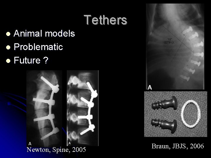 Tethers Animal models l Problematic l Future ? l Newton, Spine, 2005 Braun, JBJS, Tethers Animal models l Problematic l Future ? l Newton, Spine, 2005 Braun, JBJS,