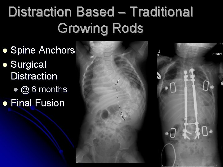 Distraction Based – Traditional Growing Rods Spine Anchors l Surgical Distraction l l@ l Distraction Based – Traditional Growing Rods Spine Anchors l Surgical Distraction l l@ l