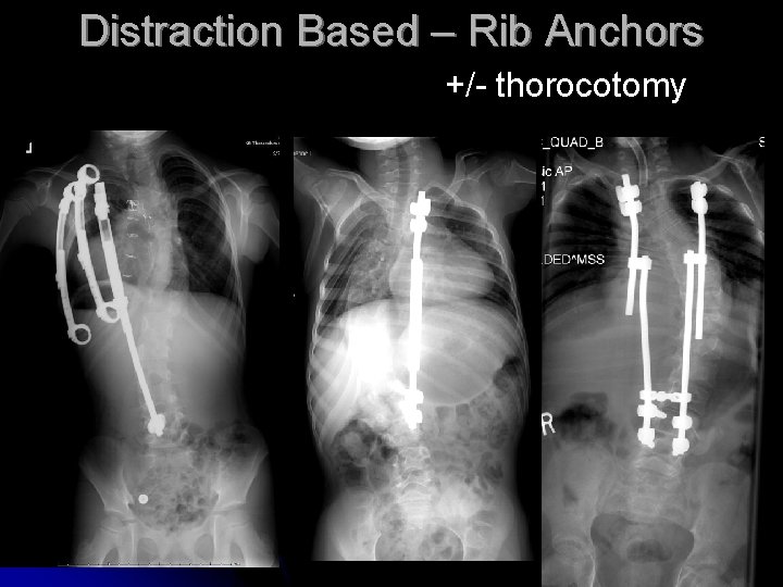 Distraction Based – Rib Anchors +/- thorocotomy Distraction Based – Rib Anchors +/- thorocotomy