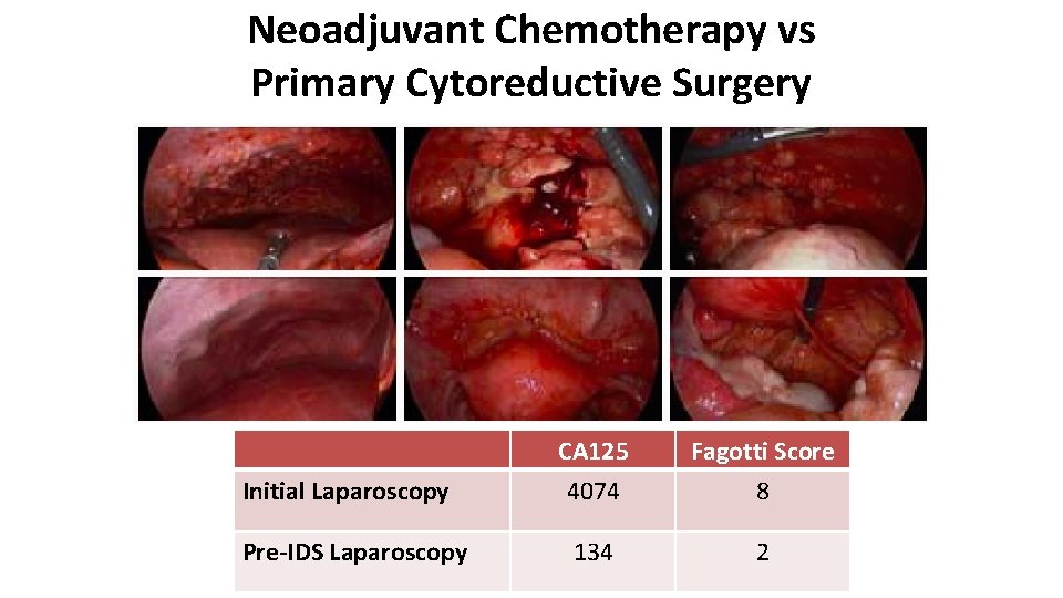 Neoadjuvant Chemotherapy vs Primary Cytoreductive Surgery Initial Laparoscopy Pre-IDS Laparoscopy CA 125 4074 Fagotti