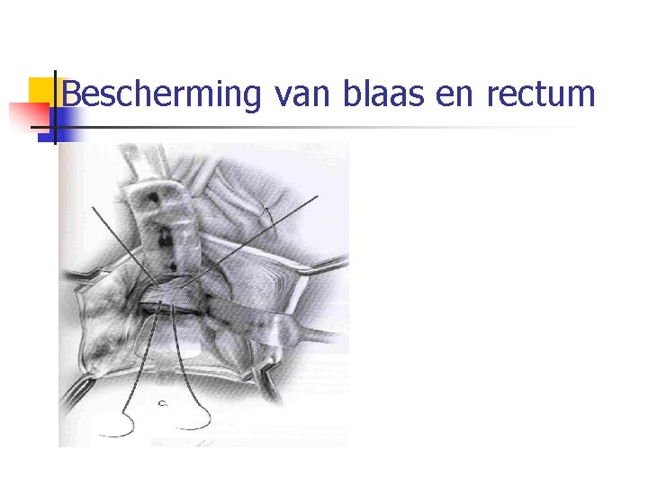 Bescherming van blaas en rectum 