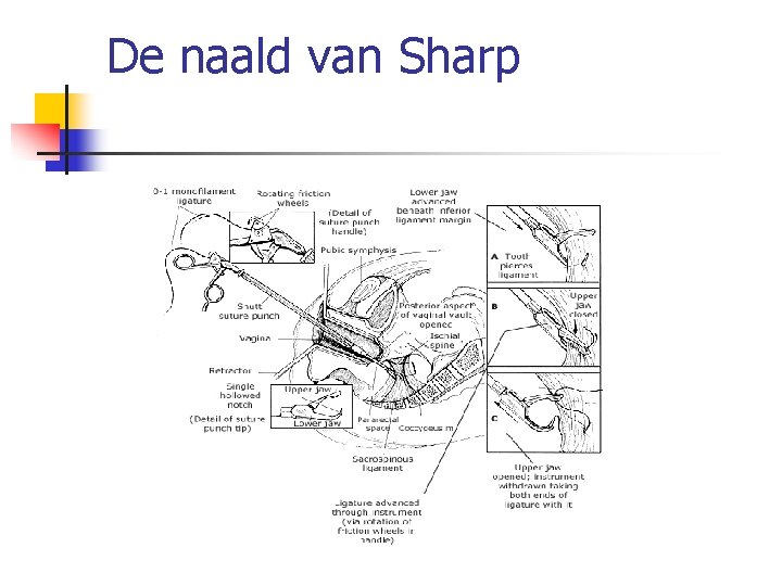 De naald van Sharp 