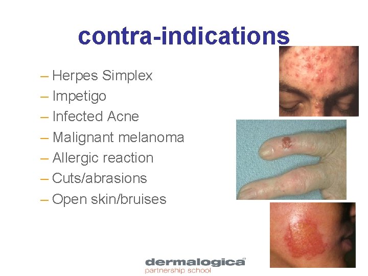 contra-indications – Herpes Simplex – Impetigo – Infected Acne – Malignant melanoma – Allergic