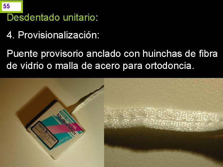 55 Desdentado unitario: 4. Provisionalización: Puente provisorio anclado con huinchas de fibra de vidrio