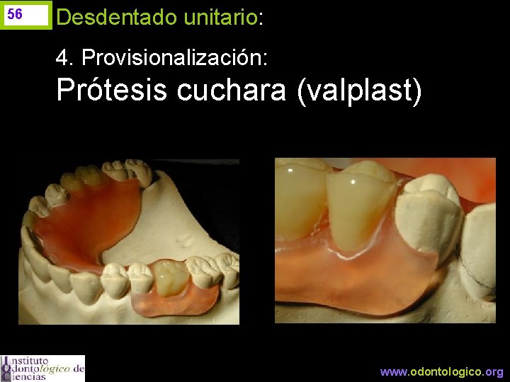 56 Desdentado unitario: 4. Provisionalización: Prótesis cuchara (valplast) J. I. H. www. odontologico. org