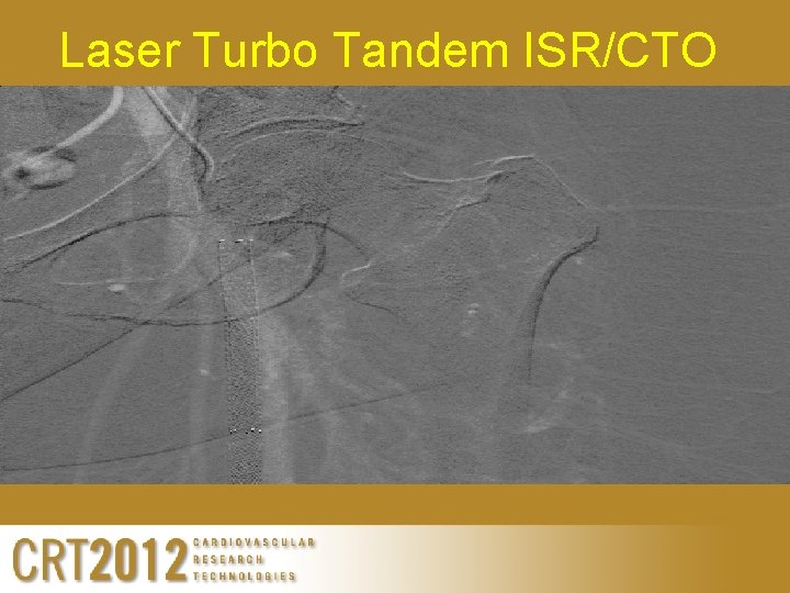 Laser Turbo Tandem ISR/CTO Laser Turbo Tandem ISR/CTO