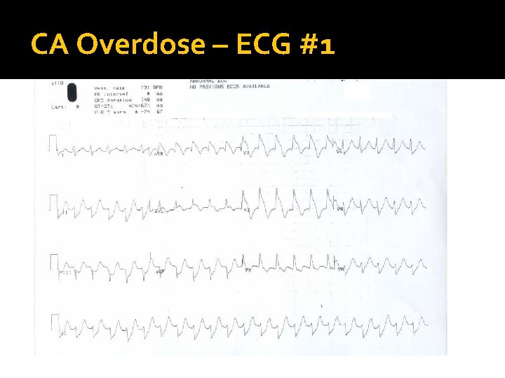 CA Overdose – ECG #1 