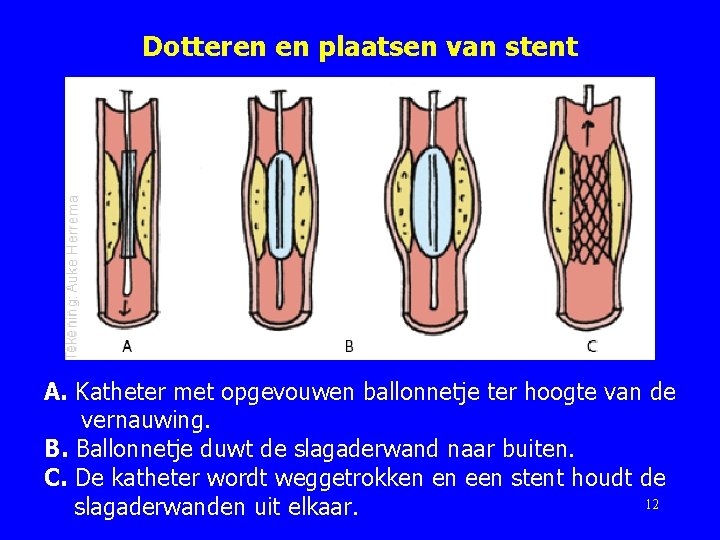 Dotteren en plaatsen van stent A. Katheter met opgevouwen ballonnetje ter hoogte van de