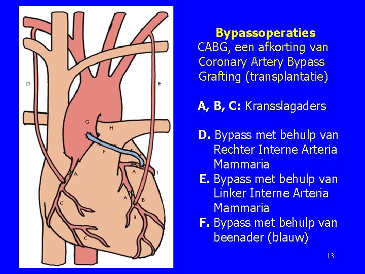 Bypassoperaties CABG, een afkorting van Coronary Artery Bypass Grafting (transplantatie) A, B, C: Kransslagaders