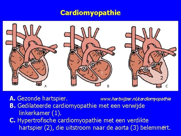 Cardiomyopathie A. Gezonde hartspier. www. hartwijzer. nl/cardiomyopathie B. Gedilateerde cardiomyopathie met een verwijde linkerkamer